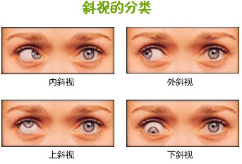 孩子斜視是怎么回事