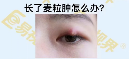 長(zhǎng)了麥粒腫怎么辦