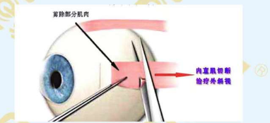斜視手術(shù)需前需要滿足的條件