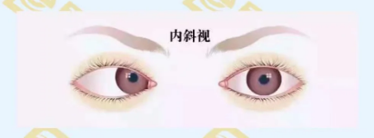 什么是調(diào)節(jié)性內(nèi)斜視？