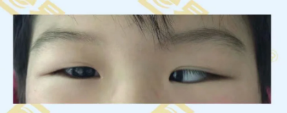 什么是先天性內(nèi)斜視?