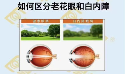 如何區(qū)分老花眼和白內(nèi)障？